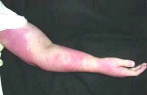 Симптомы и лечение рожистого воспаления: ноги, руки, кожи лица