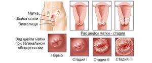 Рак шейки матки: симптомы, лечение, анализы, диагностика, рецидив