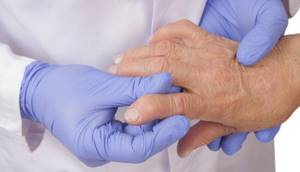 Ревматоидный артрит: симптомы, диагностика, лечение заболевания суставов