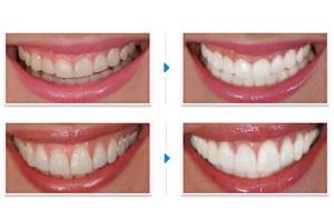Отбеливание зубов: в домашних условиях, методы в стоматологии без вреда для здоровья