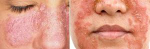 Себорея: кожи головы, на лице, лечение жирной и сухой себореи