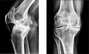 Артроз коленного сустава симптомы, причина, степени