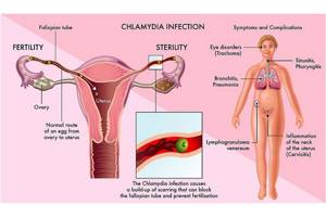 Хламидии у женщин, мужчин: симптомы, лечение