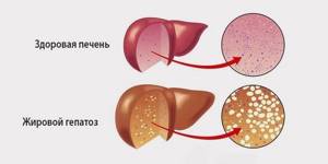 Жировой гепатоз печени: симптомы, причины