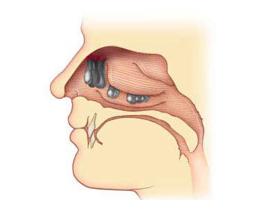 Хирургичекое лечение полипов в носу. Симптомы и причины развития патологии,