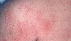 Аллергия на солнце - симптомы, лечение