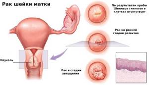 Рак матки: симптомы, лечение, причины, диагностика, стадии, прогноз