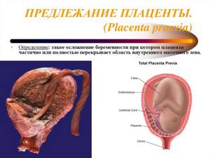 Предлежание плаценты (хореона): чем опасно такое состояние беременной. Почему возникает и что делать при такой беременности?