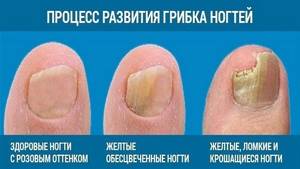 Лак от грибка ногтей: лечение грибка на ногтях ног и рук