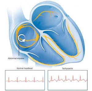 Тахикардия - причины возникновения учащенного сердцебиения