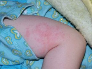 Шершавая кожа у ребенка: причины, что делать