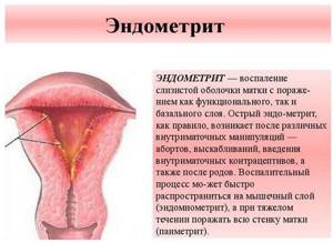 Эндометрит: лечение хронического и острого эндометрита, можно ли забеременеть