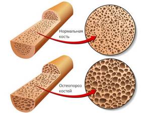 Бисфосфонаты для лечения остеопороза и прочие группы препаратов при остеопорозе