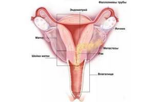 Рак матки: симптомы, лечение, причины, диагностика, стадии, прогноз