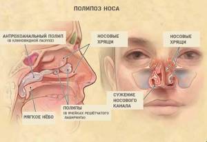 Заложен нос: что делать, причины постоянной заложенности носа у ребенка, взрослого