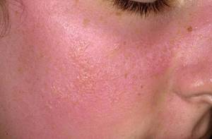 Аллергия на солнце - симптомы, лечение