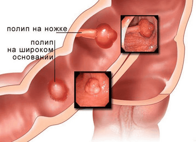 Полипы в кишечнике: симптомы, лечение, удаление