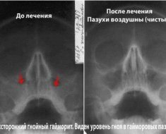 Рентген пазух носа: как делают, описание при гайморите, что показывает