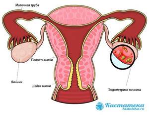 Эндометриоидная киста яичника: операция, лечение,  народные средства