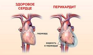 Учащенное сердцебиение: причины, физиологические и патологические, что делать, лечение