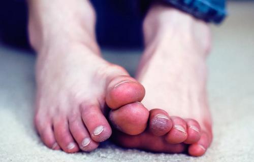 Почему немеют пальцы ног: причины