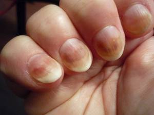 Почему желтеют ногти на руках и ногах: лечение, причины