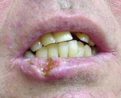 Рак губы: симптомы, первые признаки, причины, лечение, прогноз