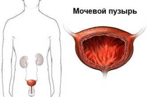 Признаки рака мочевого пузыря