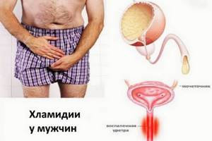 Хламидиоз у мужчин - симптомы, лечение, схемы, последствия