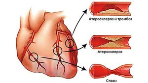 Ишемическая болезнь сердца, симптомы, варианты развития заболевания