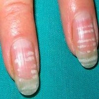 Белые пятна на ногтях: почему появляются, что означает, как удалить