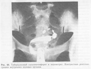 Туберкулез женских половых органов: симптомы, диагностика, лечение