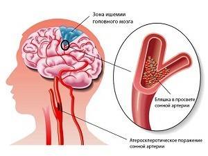 Энцефалопатия головного мозга: симптомы, лечение, диагностика, причины