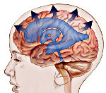 Гидроцефалия головного мозга у взрослых- симптомы, лечение