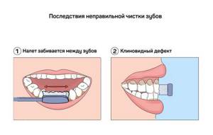 Какую зубную щетку и пасту выбрать для взрослого, как правильно чистить зубы