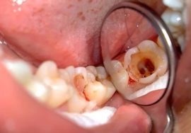 Средства от зубной боли: обезболивающие лекарства, народные средства, какие таблетки помогают