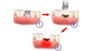 После удаления зуба: что делать, чем полоскать, боль, десна, кровь, опухла щека, рана, осложнения