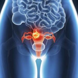 Биопсия шейки матки: расшифровка результата, что после нее можно нельзя, подготовка