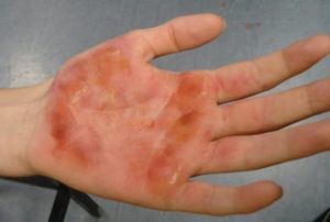 Химический ожог кожи: лечение, первая помощь в домашних условиях