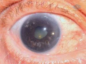 Глаукома: симптомы, лечение, причины, препараты, операция, прогноз
