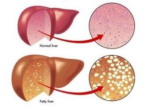 Лечение жирового гепатоза печени