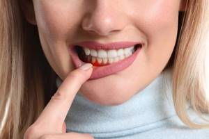 Использование зубной нити при кровоточивости десен может вызывать воспаление суставов