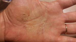 Трещины на пальцах рук: причины возникновения, лечение, крема, маски