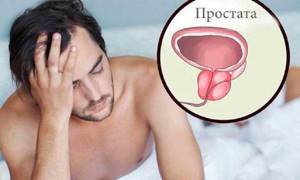 Симптомы простатита у мужчин