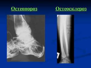 Остеосклероз: причины, лечение, костей, суставов, тел позвонков